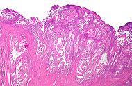 Endometrial_adenocarcinoma_low_mag.jpg