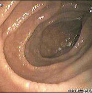 180px-Celiac_disease.jpg
