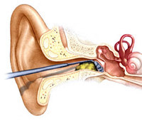 Earwax_1.jpg