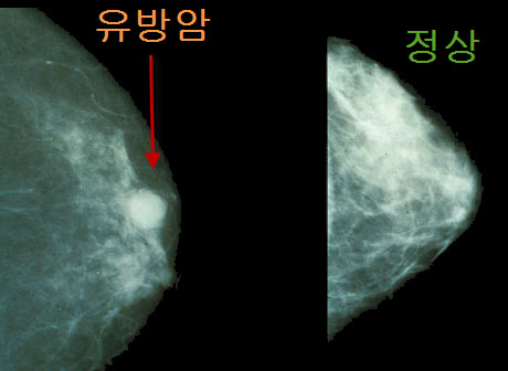 Mammo_breast_cancer_compa.jpg