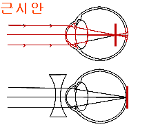 Myopic_eye.png